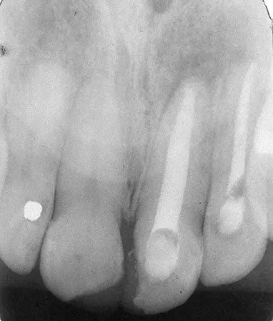 Leggi l'articolo Trattamento di successo di una lesione periapicale di lunga durata