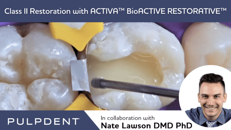 Leggi l'articolo Restauro di classe II con ACTIVA™ BioACTIVE-RESTORATIVE™