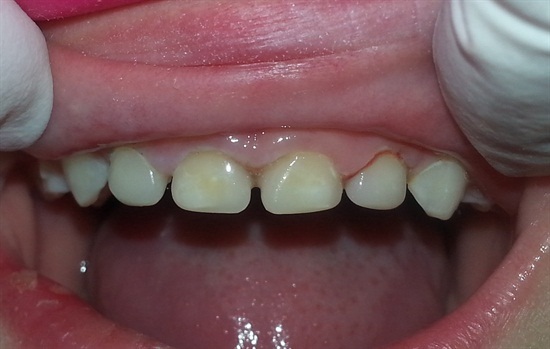 Leggi l'articolo Odontoiatria eroica: Spogliare le corone per Leigh