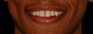 Il sorriso ritrovato di Yoseph