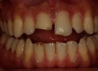 Leggi l'articolo Odontoiatria eroica: Come Yoseph ha ritrovato il suo sorriso