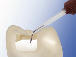 Leggi l'articolo Altri 5 modi per utilizzare ACTIVA BioACTIVE-RESTORATIVE
