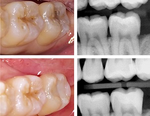 Leggi l'articolo Odontoiatria eroica: La tecnica del sandwich aperto
