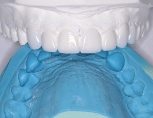 Leggi l'articolo Odontoiatria eroica: Salvataggio compassionevole del sorriso con ACTIVA BioACTIVE-RESTORATIVE