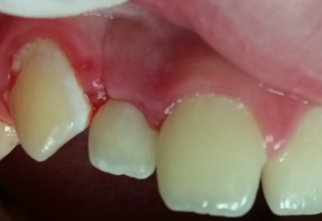 Leggi l'articolo Direttamente dalla sala operatoria: Riempimento in massa con ACTIVA BioACTIVE-RESTORATIVE