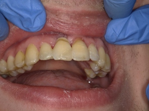 Leggi l'articolo Odontoiatria eroica: Trauma, riassorbimento esterno, estrazione e splintaggio della corona naturale con ACTIVA