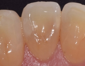 Leggi l'articolo Uso di materiali da restauro bioattivi in pazienti ad alto rischio di carie