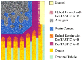 Bonding-Amalgam-to-Dentin