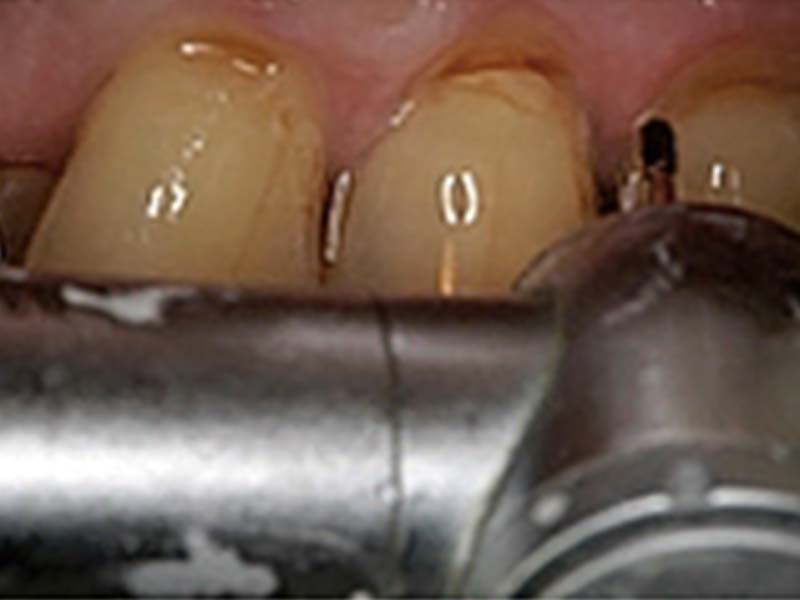 clinical-procedure-embrace-class-v-2