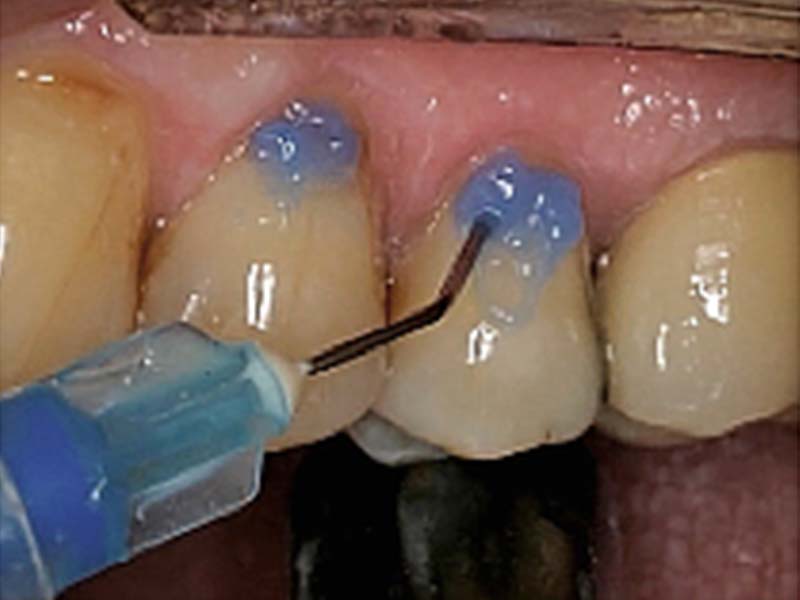 clinical-procedure-embrace-class-v-3
