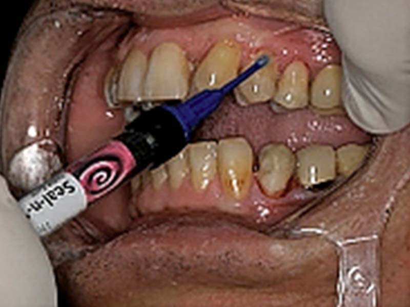 clinical-procedure-embrace-class-v-6
