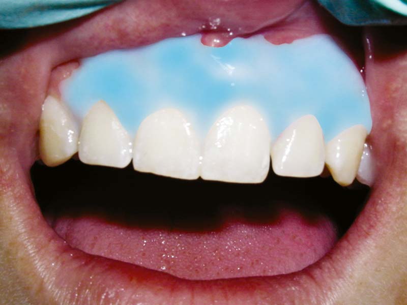 clinical-procedure-kool-dam-2