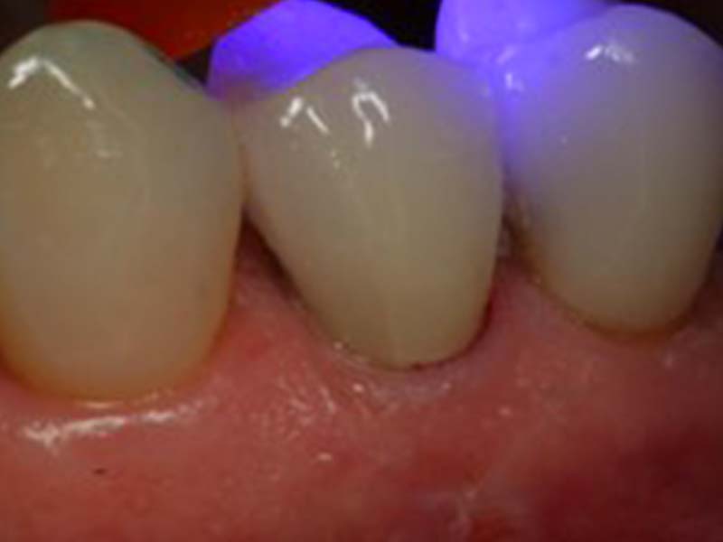 clinical-procedure-pfm-repair-kit-9