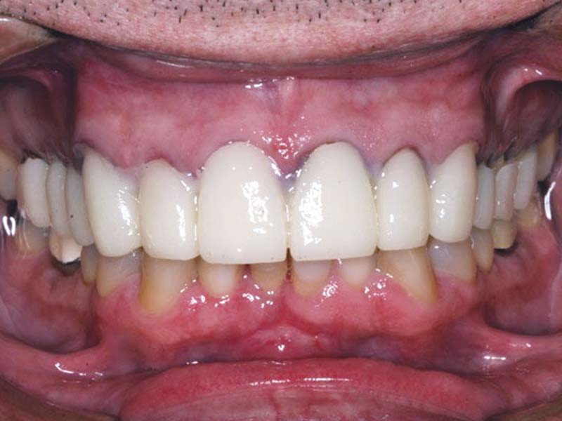 clinical-procedure1-tuff-temp-plus-3