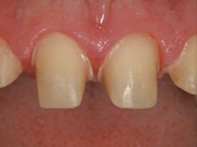 clinical-procedure2-kleer-veneer-1
