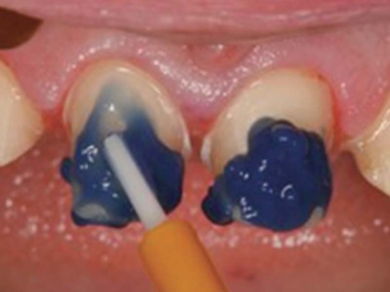 clinical-procedure2-kleer-veneer-2