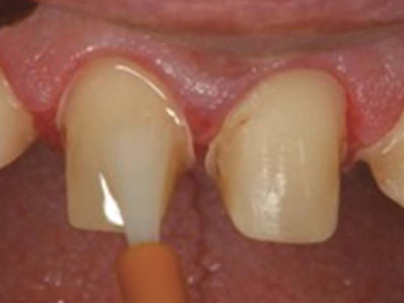 clinical-procedure2-kleer-veneer-3