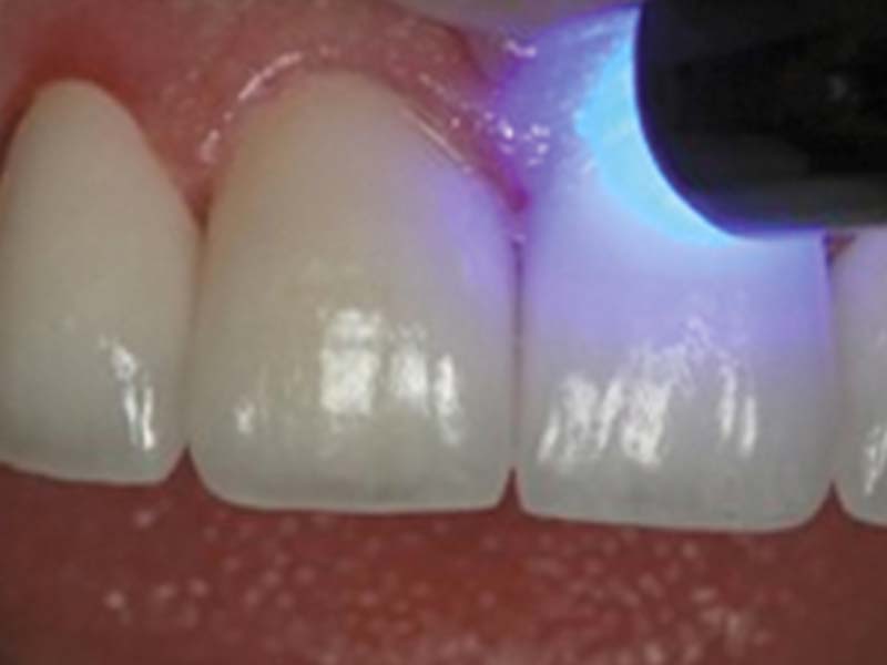 clinical-procedure2-kleer-veneer-6