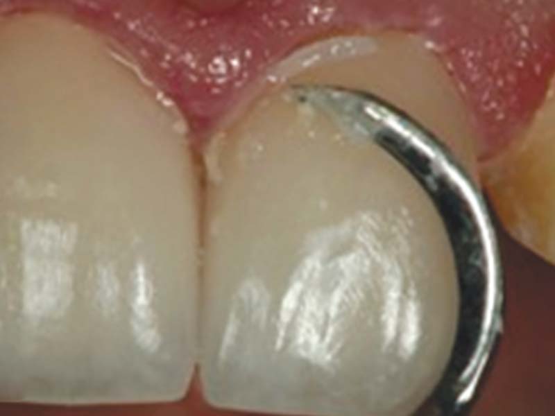 clinical-procedure2-kleer-veneer-8