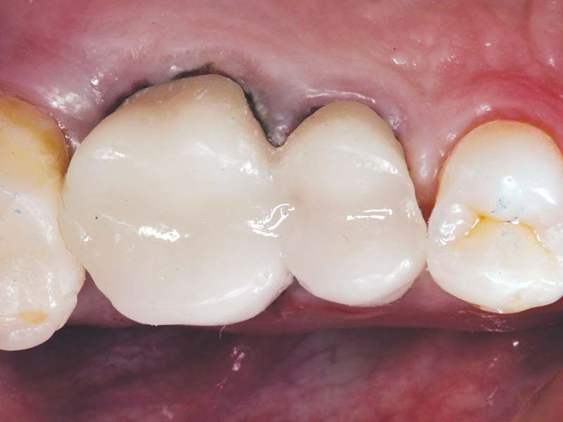 clinical-procedure2-tuff-temp-plus-4
