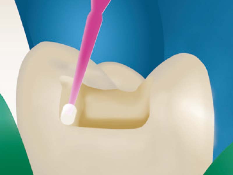 clinical-procedure-activa-presto-3