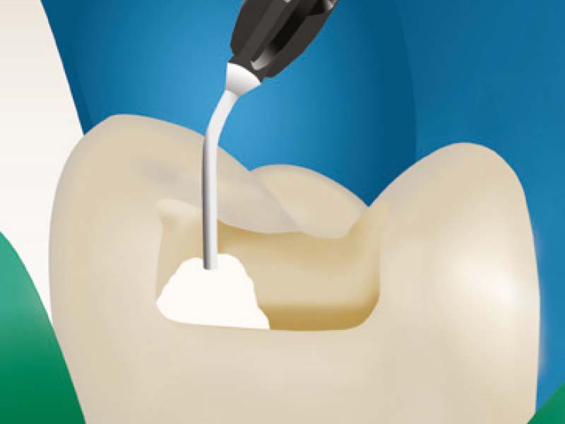 clinical-procedure-activa-presto-4