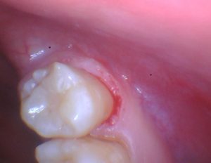 Leggi l'articolo Direttamente dalla sala operatoria: Restauro bioattivo di un dente del giudizio cariato