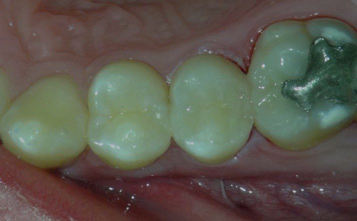 Leggi l'articolo Direttamente dalla sala operatoria: Restauri bioattivi minimamente invasivi