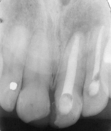 Leggi l'articolo Trattamento di successo di una lesione periapicale di lunga durata