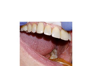 Leggi l'articolo Odontoiatria eroica: Riutilizzare una corona rotta