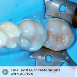 Odontoiatria eroica: Restauri ACTIVA rapidi, efficaci, in una sola visita e a più unità