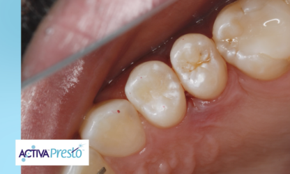 NUOVO VIDEO! Il Dr. Joshua Austin x Dental Economics presentano ACTIVA Presto