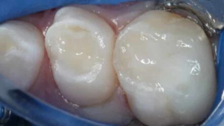 Restauri bioattivi in odontoiatria pediatrica