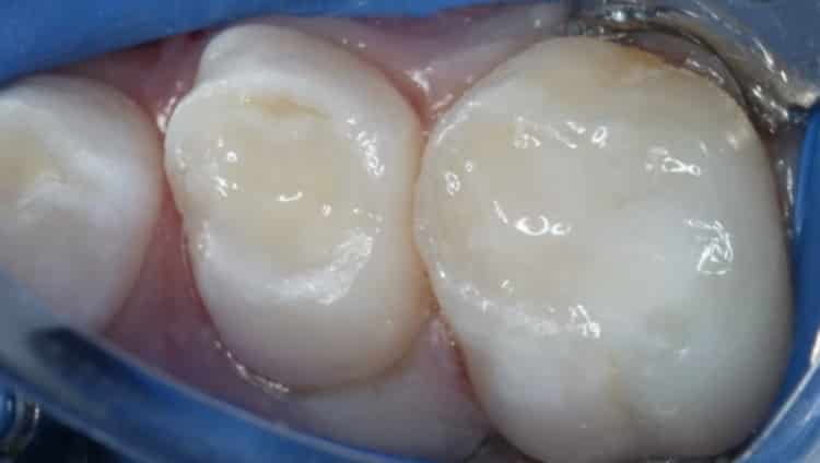 Leggi l'articolo Restauri bioattivi in odontoiatria pediatrica