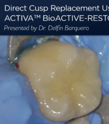 Sostituzione diretta della cuspide con un restauro bioattivo