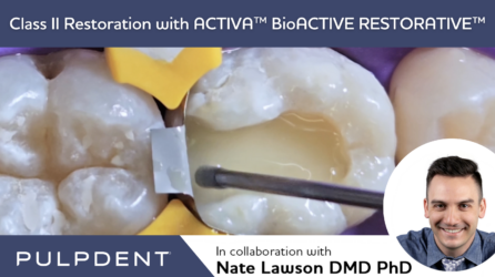 Restauro di classe II con ACTIVA™ BioACTIVE-RESTORATIVE™
