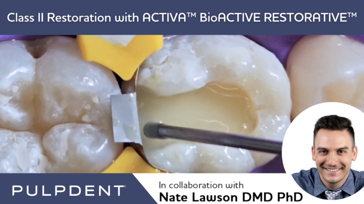 Leggi l'articolo Restauro di classe II con ACTIVA™ BioACTIVE-RESTORATIVE™